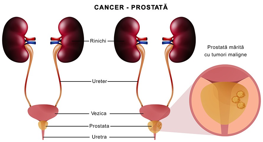 de la ce faci cancer de prostata